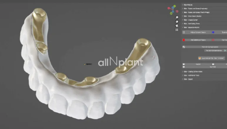 치과 CAD 프로그램을 활용한 풀아치 보철 디지털 설계 과정